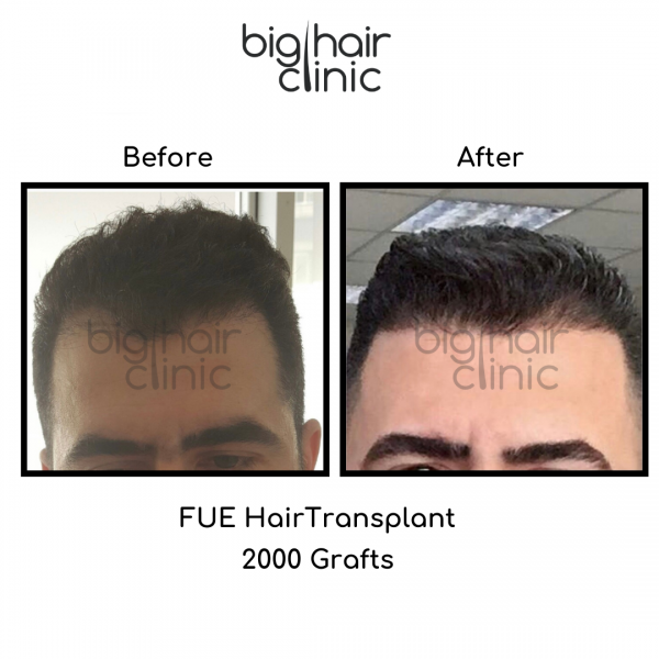 Hair Transplant Price in Turkey | Full Package | Big Hair Clinic